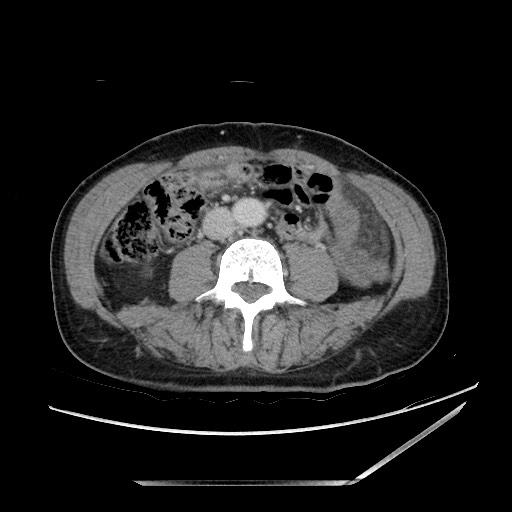 Closed loop small bowel obstruction - omental adhesion causing "internal hernia" (Radiopaedia 85129-100682 A 95).jpg