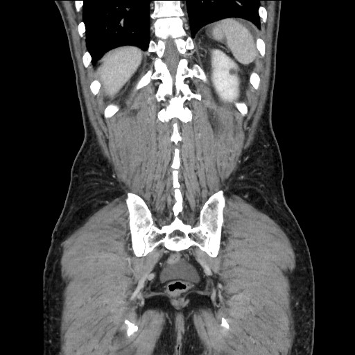 File:Closed loop small bowel obstruction - omental adhesion causing "internal hernia" (Radiopaedia 85129-100682 B 105).jpg