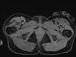 File:Closed loop small bowel obstruction in pregnancy (MRI) (Radiopaedia 87637-104031 G 33).jpg