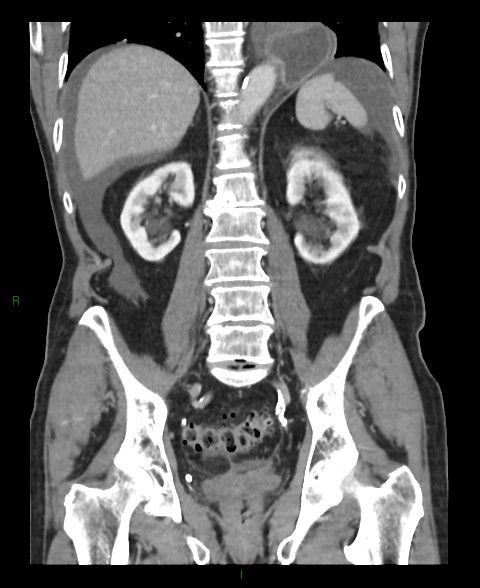 Closed loop small bowel obstruction with ischemia (Radiopaedia 84180-99456 B 23).jpg