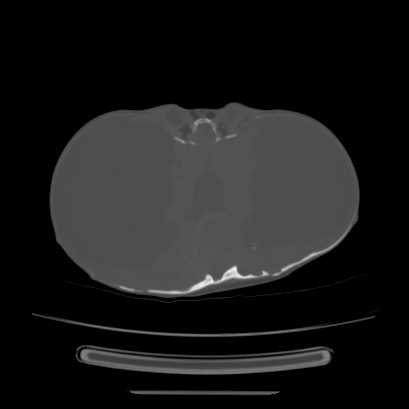 Cloverleaf skull (Radiopaedia 91901-109710 Axial bone window 81).jpg