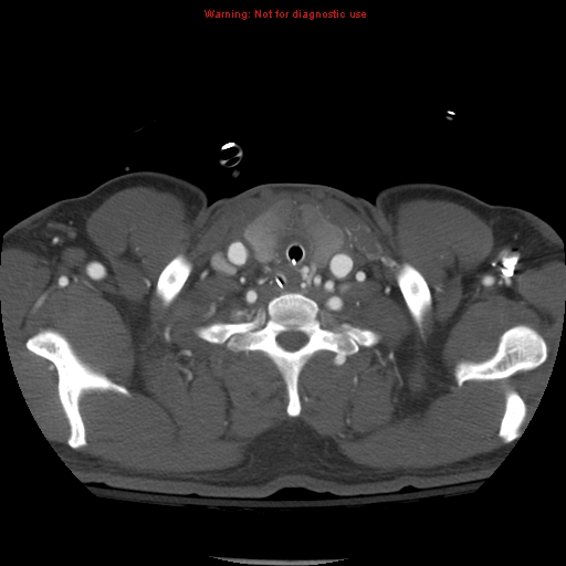 File:Coarctation of the aorta (Radiopaedia 8681-9490 B 7).jpg
