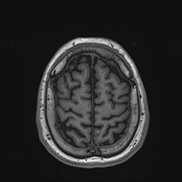 File:Cochlear incomplete partition type III associated with hypothalamic hamartoma (Radiopaedia 88756-105498 Axial T1 164).jpg