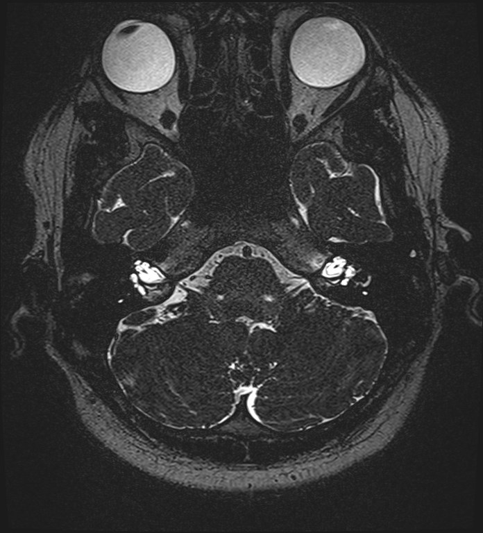 Cochlear incomplete partition type III associated with hypothalamic hamartoma (Radiopaedia 88756-105498 Axial T2 65).jpg