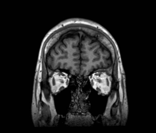 File:Cochlear incomplete partition type III associated with hypothalamic hamartoma (Radiopaedia 88756-105498 Coronal T1 53).jpg
