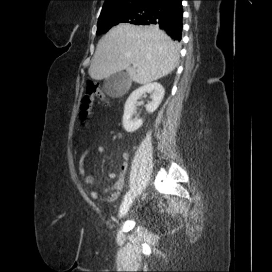 File:Collection due to leak after sleeve gastrectomy (Radiopaedia 55504-61972 C 43).jpg