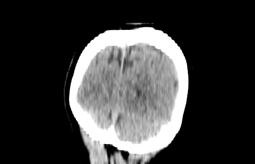 Colloid cyst (Radiopaedia 88663-105373 Coronal non-contrast 62).jpg