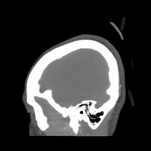 File:Colloid cyst (resulting in death) (Radiopaedia 33423-34499 B 49).png