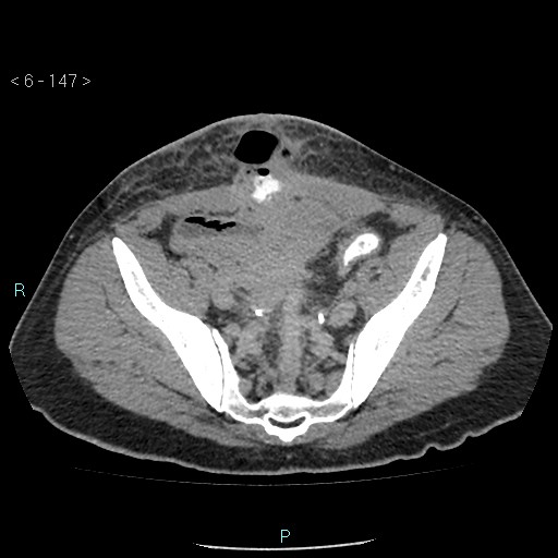 File:Colo-cutaneous fistula (Radiopaedia 40531-43129 A 61).jpg