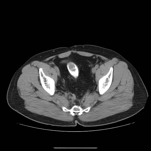 File:Colocutaneous fistula in Crohn's disease (Radiopaedia 29586-30093 D 34).jpg