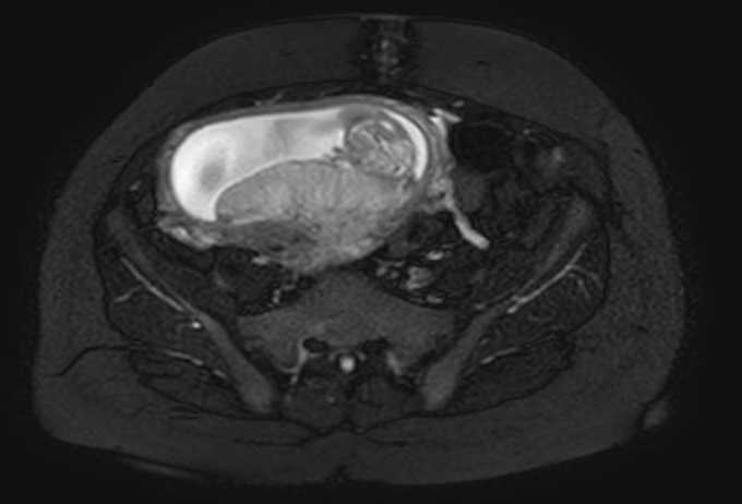 Colon adenocarcinoma with Krukenberg tumors, advanced pregnancy (Radiopaedia 67279-76645 Axial T2 SPAIR 24).jpg