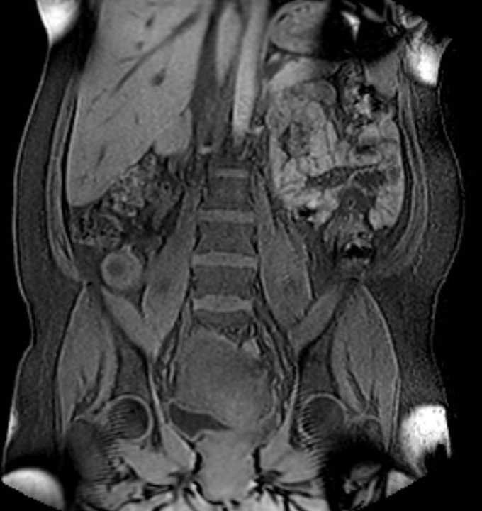 Colon adenocarcinoma with Krukenberg tumors, advanced pregnancy (Radiopaedia 67279-76645 E 53).jpg