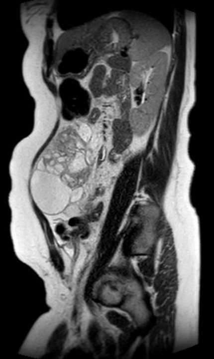 Colon adenocarcinoma with Krukenberg tumors, advanced pregnancy (Radiopaedia 67279-76645 Sagittal T2 18).jpg