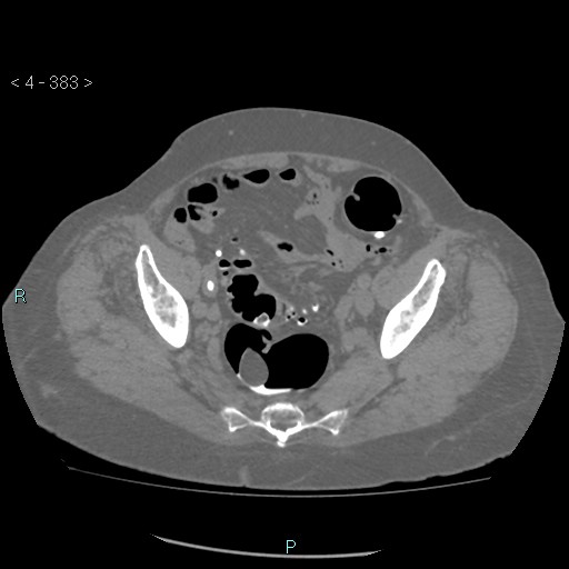 File:Colonic lipomas (Radiopaedia 49137-54244 Axial bone window 171).jpg