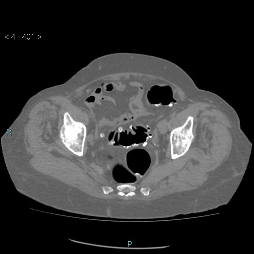 File:Colonic lipomas (Radiopaedia 49137-54244 Axial bone window 179).jpg