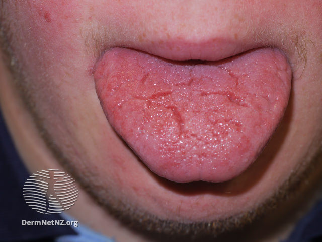 File:Fissured tongue (DermNet NZ down-syndrome-02).jpg