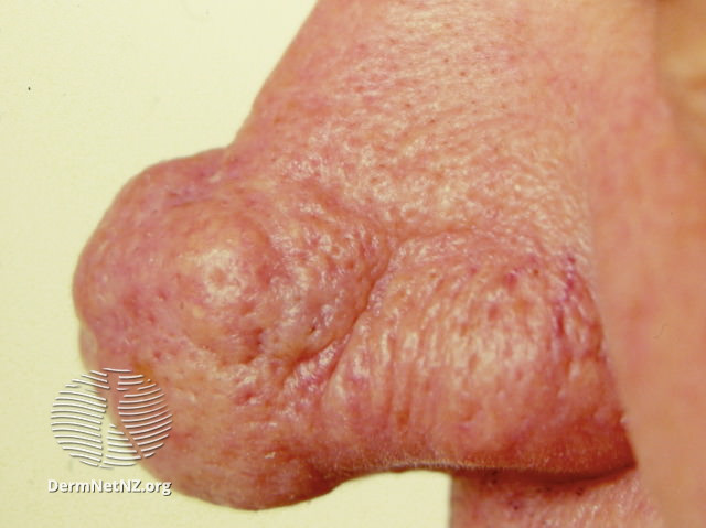 File:Grade 3 (DermNet NZ acne-rhinophyma-06).jpg
