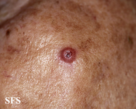 File:Melanoma (Dermatology Atlas 19).jpg