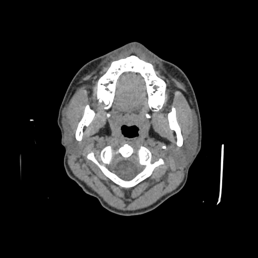 Nasal pyogenic granuloma (lobular capillary hemangioma) (Radiopaedia 85536-101244 Axial non-contrast 1).jpg