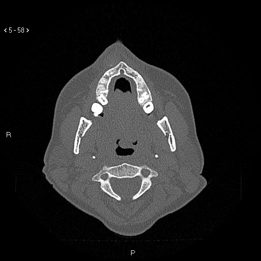 Nasolabial cyst (Radiopaedia 75125-86194 Axial bone window 19).jpg