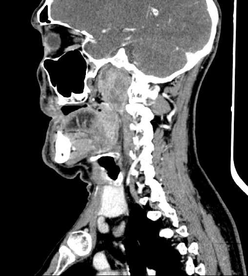 File:Nasopharyngeal carcinoma - infiltrating the clivus (Radiopaedia 62583-70875 C 20).jpg