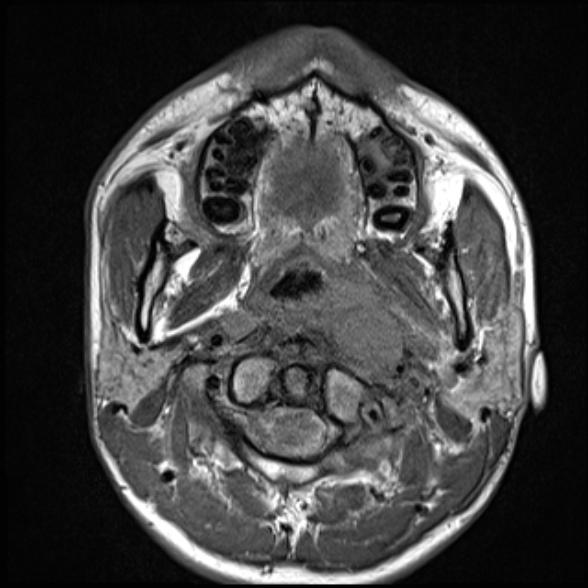 Nasopharyngeal carcinoma with skull base invasion (Radiopaedia 53415-59485 Axial T1 34).jpg