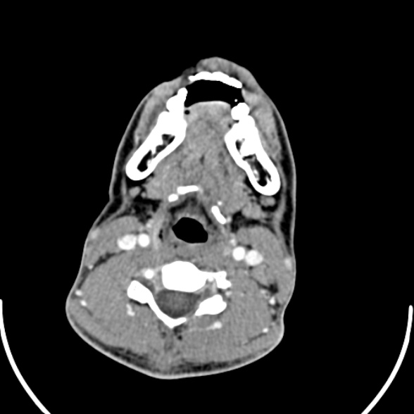 Nasopharyngeal carcinoma with skull base invasion (Radiopaedia 53415-59705 A 129).jpg