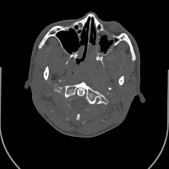 Nasopharyngeal carcinoma with skull base invasion (Radiopaedia 53415-59705 Axial bone window 49).jpg