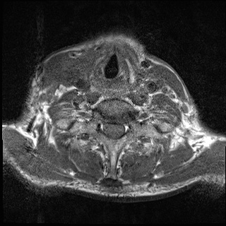 File:Nasopharyngeal carcinoma with skull base invasion (Radiopaedia 59258-66600 Axial T1 14).jpg