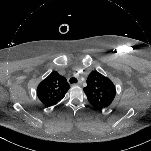 File:Neck CT angiogram (intraosseous vascular access) (Radiopaedia 55481-61945 B 74).jpg