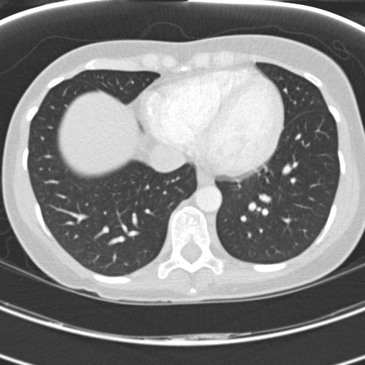 Necrobiotic pulmonary nodules - Crohn disease (Radiopaedia 20723-20631 Axial lung window 105).jpg