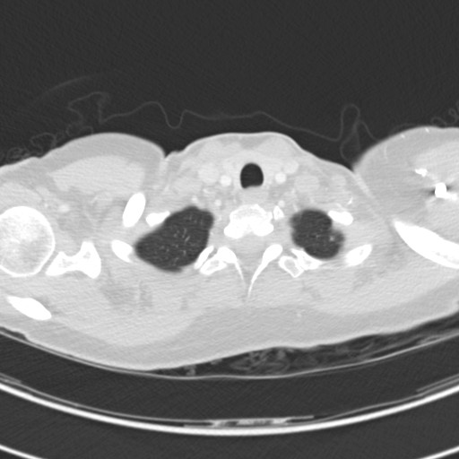 Necrobiotic pulmonary nodules - Crohn disease (Radiopaedia 20723-20631 Axial lung window 11).jpg