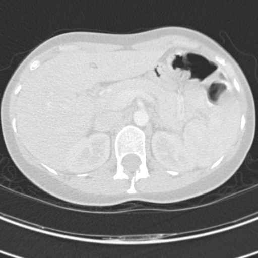 File:Necrobiotic pulmonary nodules - Crohn disease (Radiopaedia 20723-20631 Axial lung window 146).jpg