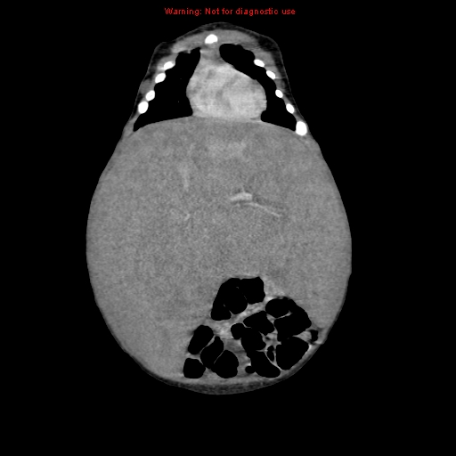File:Neonatal neuroblastoma (Radiopaedia 9564-10223 B 42).jpg