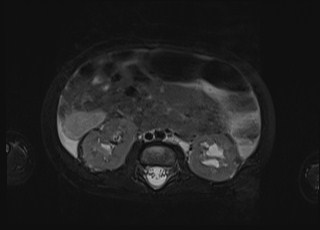 Neonatal prostatic utricle abscess - cyst (Radiopaedia 69511-79394 Axial T2 fat sat 44).jpg