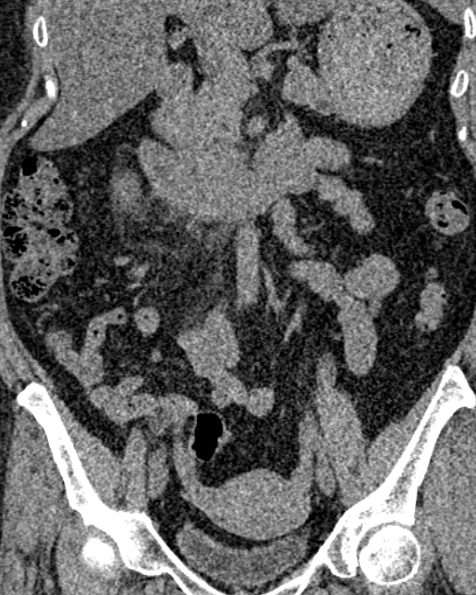 File:Nephrostomy for urosepsis (Radiopaedia 26180-26330 non-contrast 43).jpg