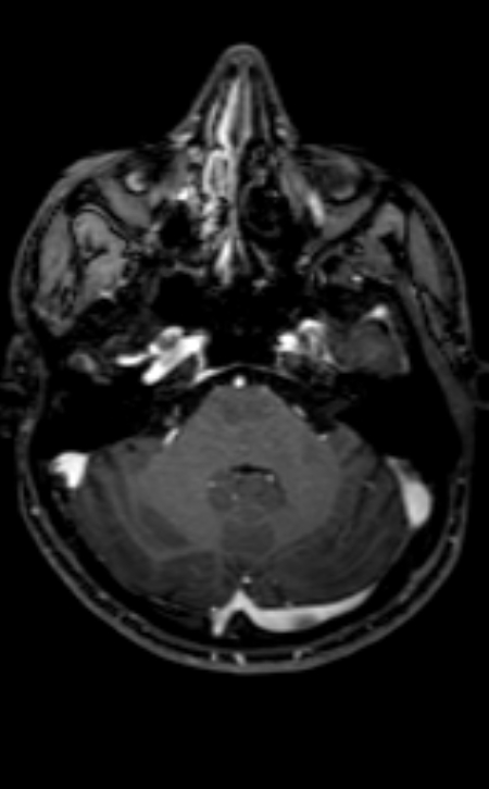Neuro-Behçet disease (Radiopaedia 90112-107294 Axial T1 C+ 170).jpg