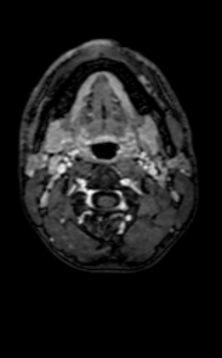 Neuro-Behçet disease (Radiopaedia 90112-107294 Axial T1 C+ 242).jpg