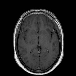 File:Neuro-Behcet's disease (Radiopaedia 21557-21505 Axial T1 C+ 11).jpg