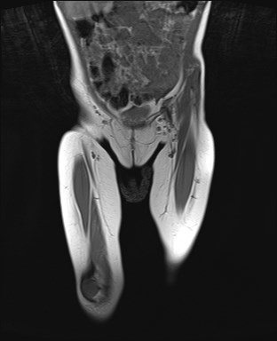File:Neuroblastoma with bone metastases (Radiopaedia 67080-76414 Coronal T1 4).jpg