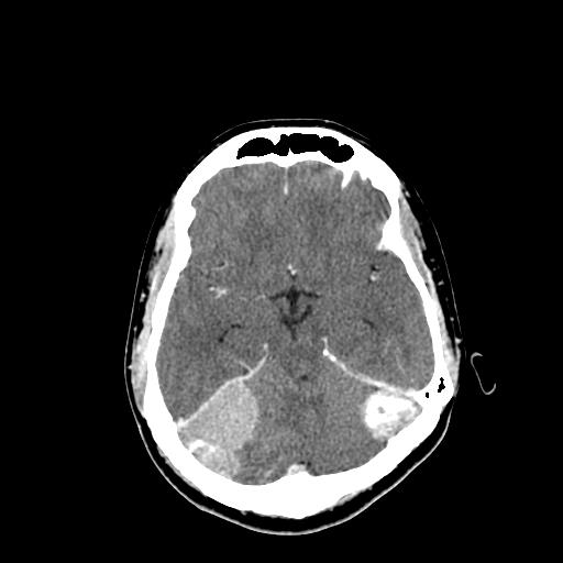 File:Neurofibromatosis type 2 (Radiopaedia 25389-25637 Axial C+ 29).jpg