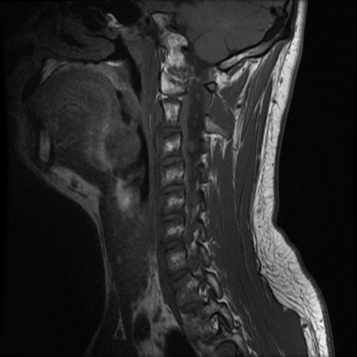 File:Neurofibromatosis type 2 (Radiopaedia 44936-48837 Sagittal T1 11).png