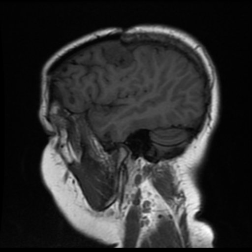 File:Neurofibromatosis type 2 (Radiopaedia 45229-49247 Sagittal T1 17).png