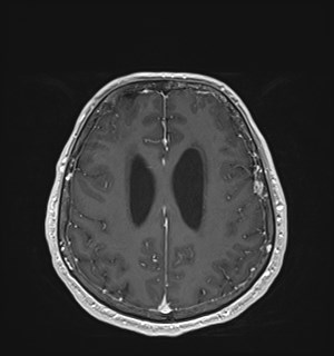 Neurofibromatosis type 2 (Radiopaedia 79097-92049 Axial T1 C+ 139).jpg