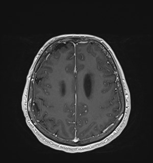 Neurofibromatosis type 2 (Radiopaedia 79097-92049 Axial T1 C+ 144).jpg