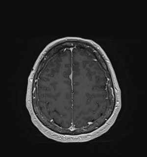 Neurofibromatosis type 2 (Radiopaedia 79097-92049 Axial T1 C+ 158).jpg