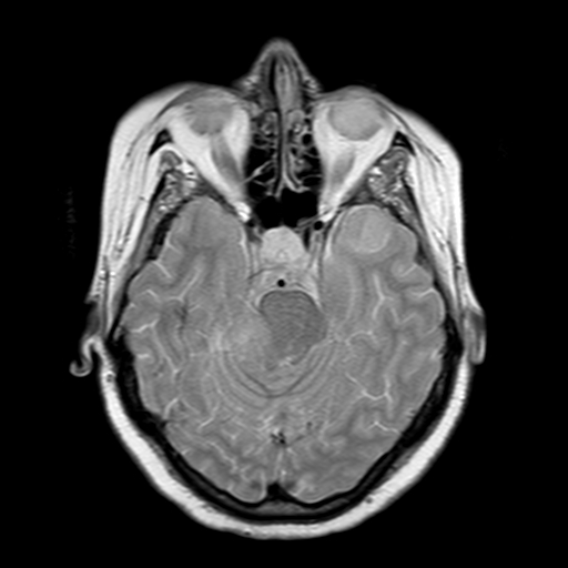 File:Neurofibromatosis type 2 (Radiopaedia 8713-9518 Axial Gradient Echo 17).jpg