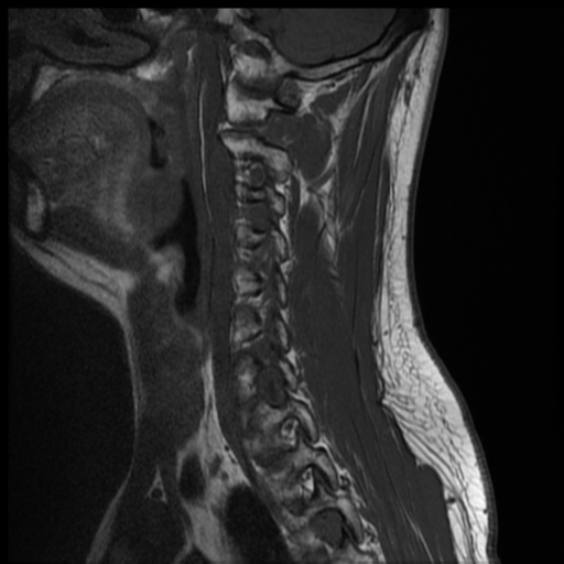 File:Neurofibromatosis type 2 (spinal manifestations) (Radiopaedia 53943-60070 Sagittal T1 10).png