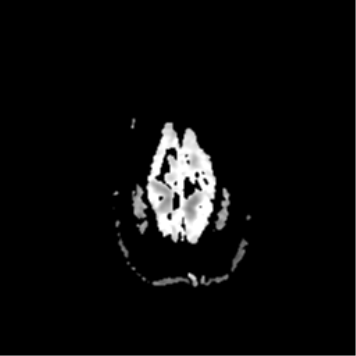 File:Neurofibromatosis type 2 - bilateral acoustic neuromata (Radiopaedia 40060-42566 Axial ADC 21).png