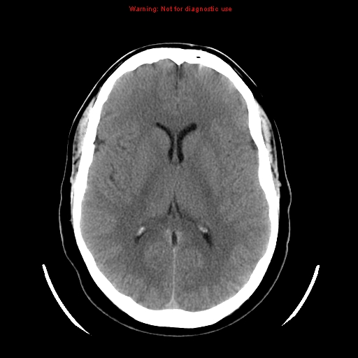 File:Neuroglial cyst (Radiopaedia 10713-11185 Axial non-contrast 16).jpg